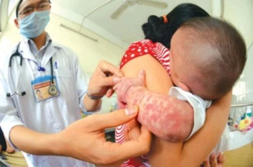 TPHCM: Đề xuất tiêm bổ sung vaccine sởi cho hơn nửa triệu trẻ